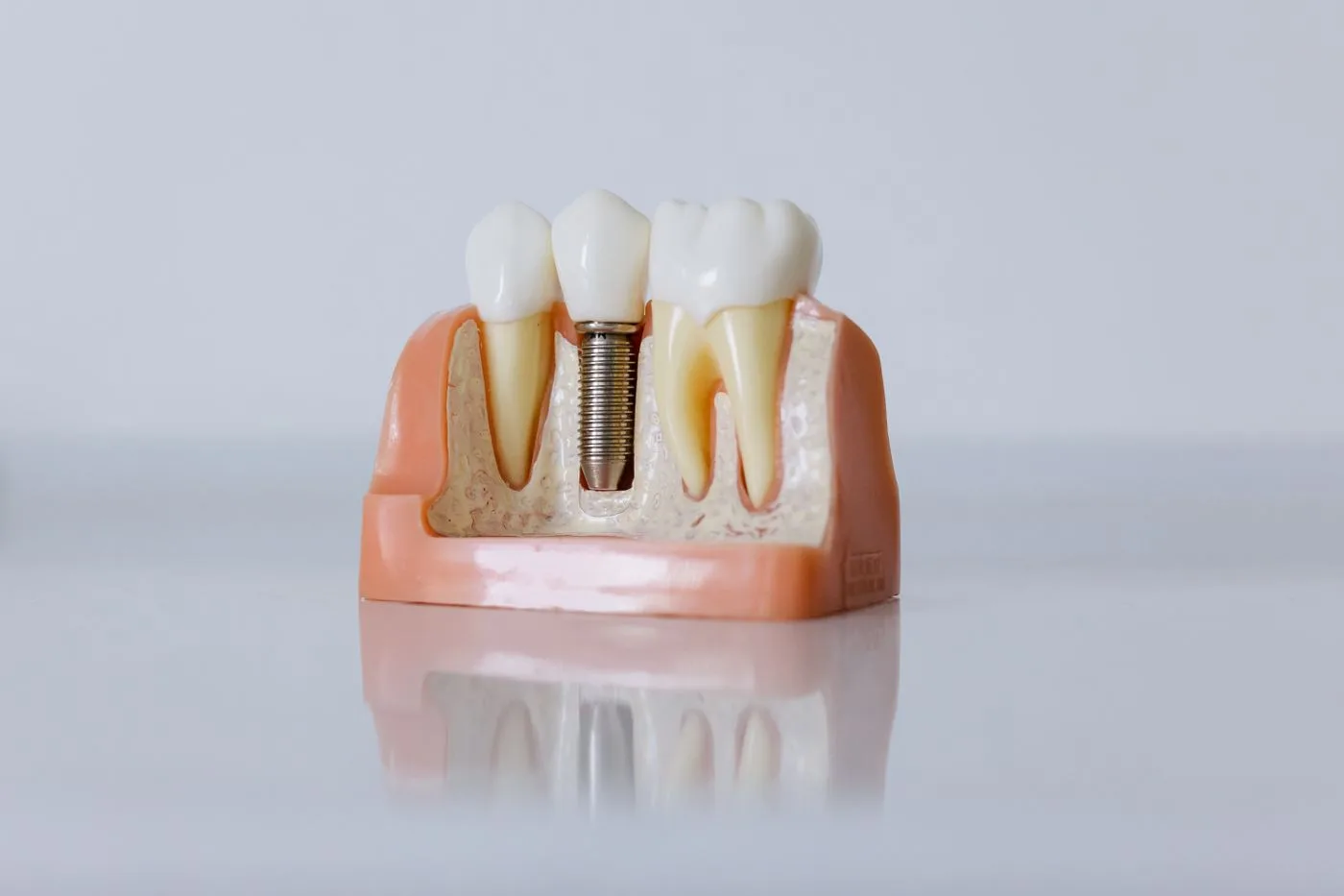 Modelo odontológico mostrando um implante com coroa entre dois dentes naturais